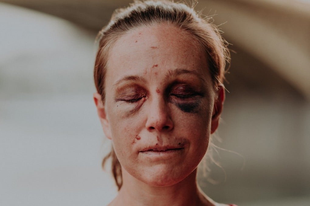 Hungarian ultramarathoner Viktória Makai shows her injuries after being attacked while out running. Photos: Sportágválasztó