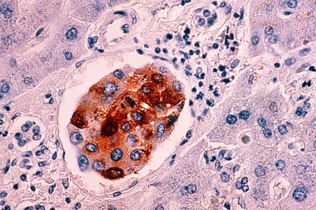 A photomicrograph of breast cancer cells metastasised to the liver. Photo: Alamy