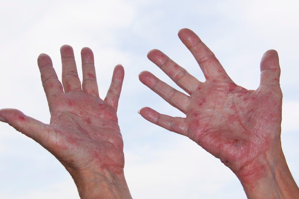 Eczema can be very itchy, prompting sufferers to scratch the affected spots, which then leaves ugly red scarring. Photo: Alamy