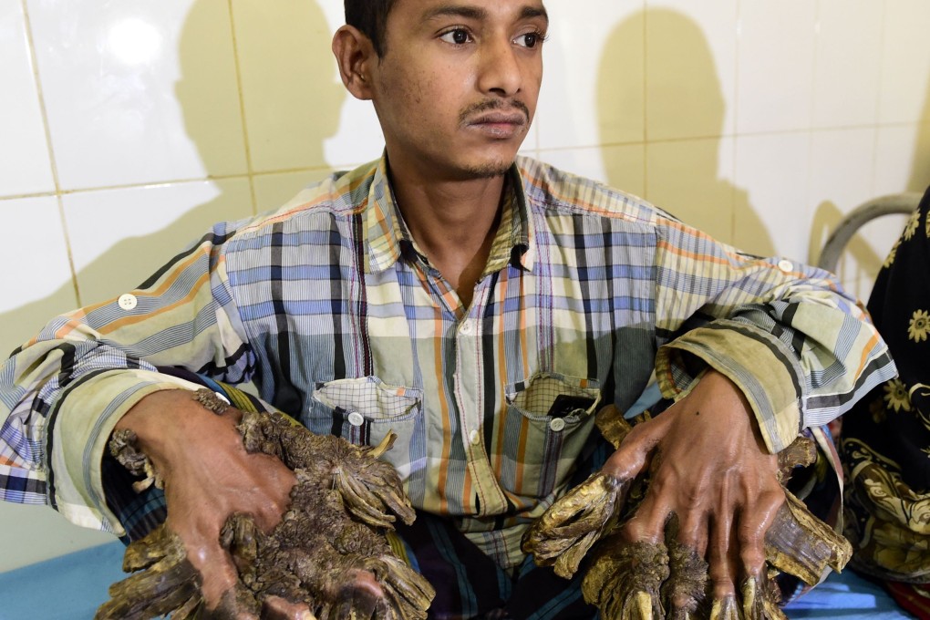 A January, 2016 photo of Bangladesh patient Abul Bajandar, who is known as ‘Tree Man’ for massive bark-like warts on his hands and feet. Photo: AFP