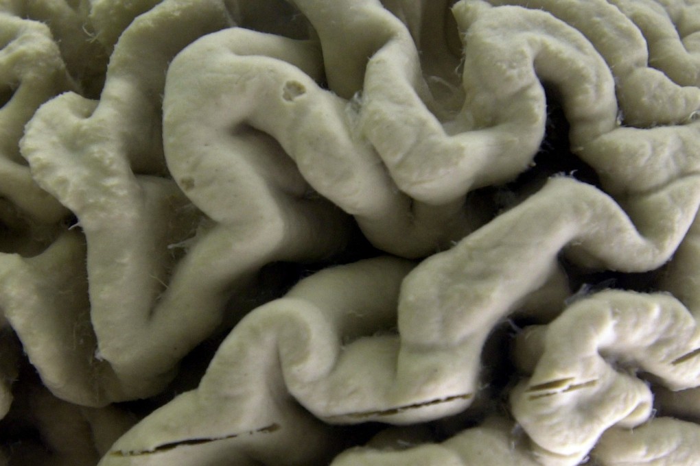 This file photo shows a section of a human brain with Alzheimer's disease on display at the Museum of Neuroanatomy at the University at Buffalo, in Buffalo, New York. Photo: AP