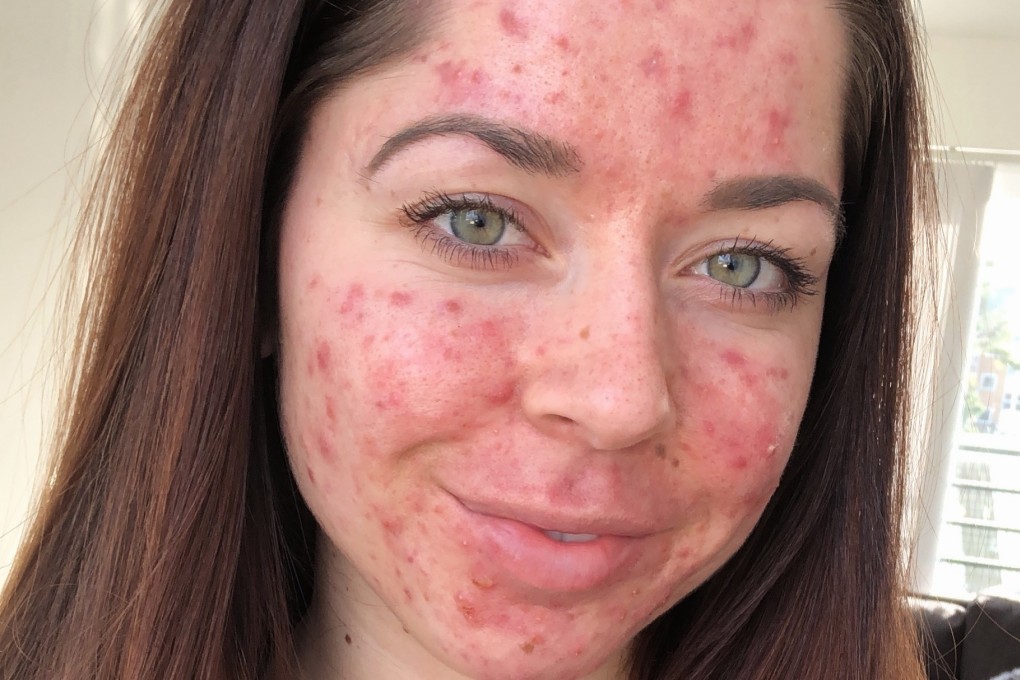 Emily Keel is a personal trainer who posts photos of her acne online to show how everybody is different.
