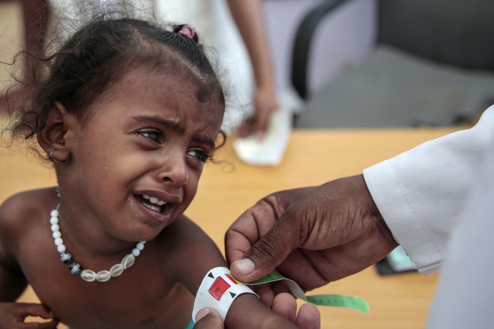 A doctor measures the arm of malnourished girl at the Aslam Health Centre in Hajjah, Yemen, in October 2018. Photo: AP
