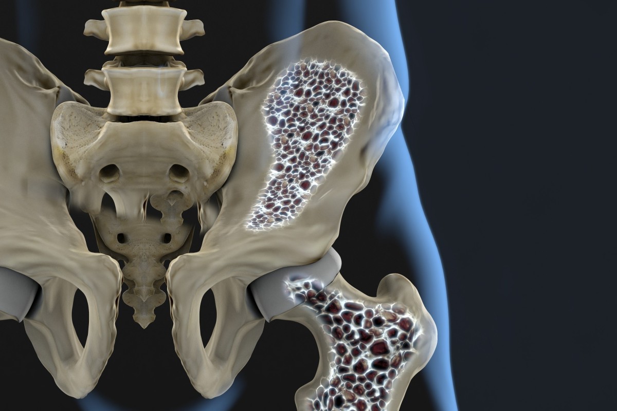Que significa osteopenia