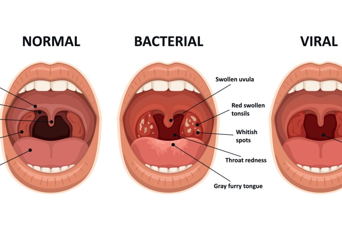 normal throat vs strep throat