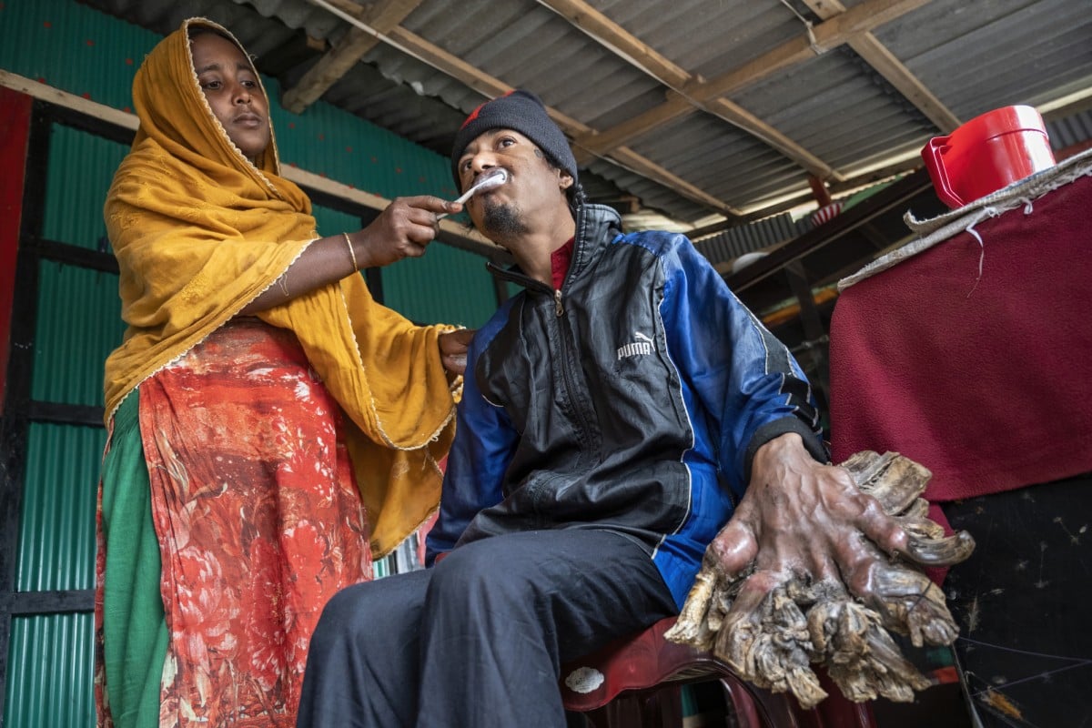 Bangladeşli “ağaç adam” ellerinin kesilmesini istiyor | Independent Türkçe, image size:1200x800