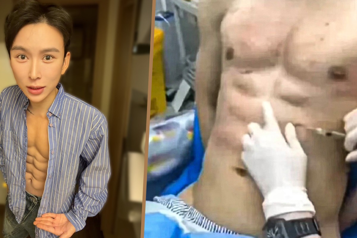 Man spends $560k on hyaluronic acid shots to create ripped physique with 8-pack abs