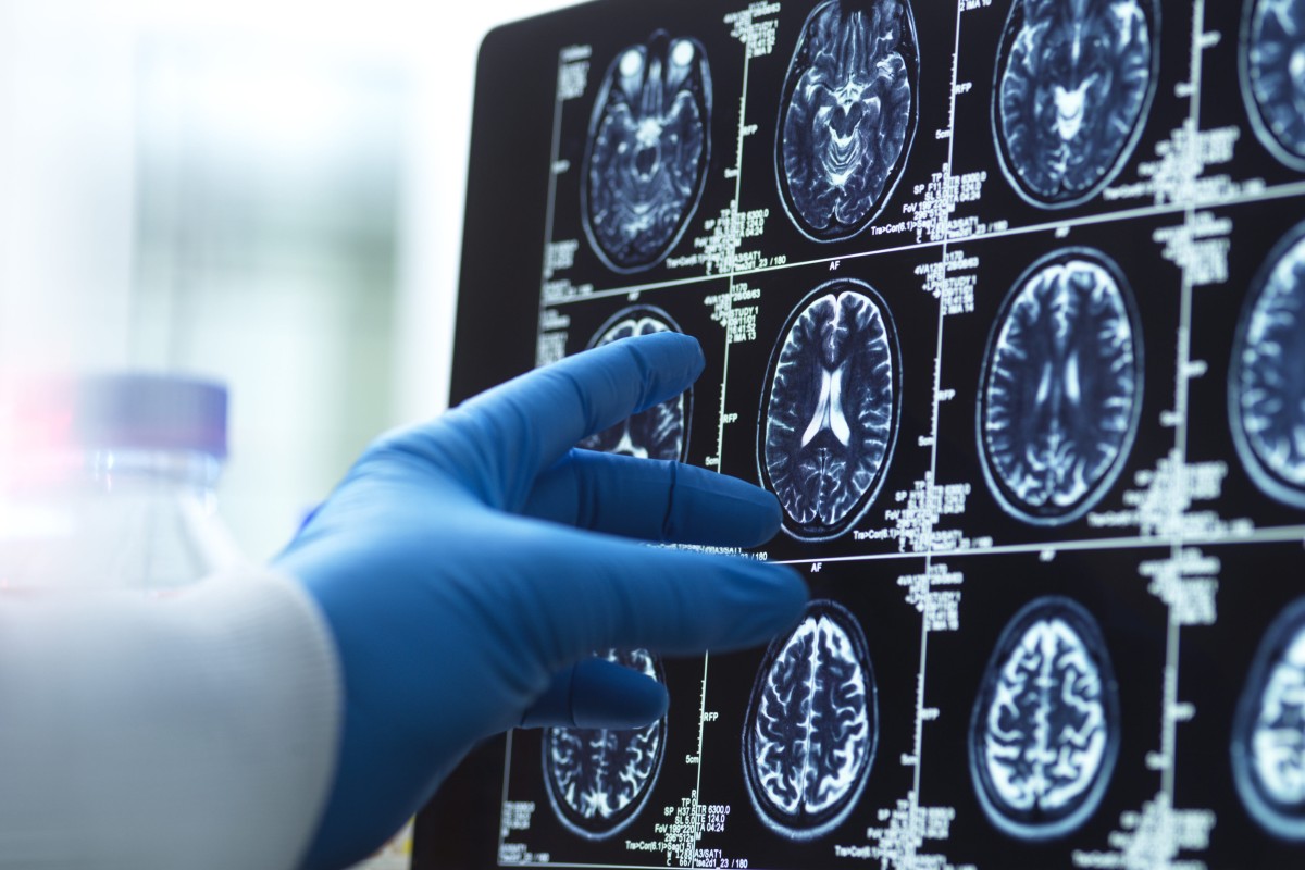Woman left on ventilator after veteran surgeon mistakenly removes healthy part of her brain