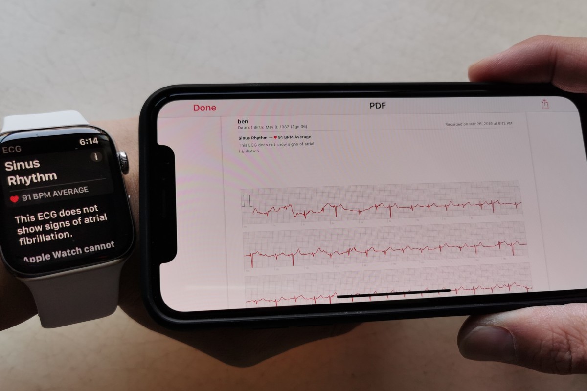 Apple Watch irregular heartbeat 
