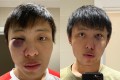 Jonathan Mok, who said he has been studying in London for two years, posted two photos of himself showing a swollen eye on his Facebook page. Photo: Handout Jonathan Mok, who said he has been studying in London for two years, posted two photos of himself showing a swollen eye on his Facebook page. Photo: Handout