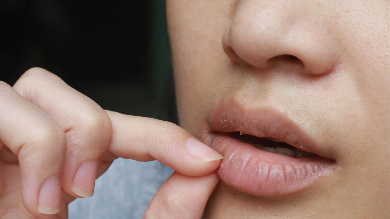 Dry, cracked lips? It could be sunburn, yeast infection, vitamin deficiencies or something else