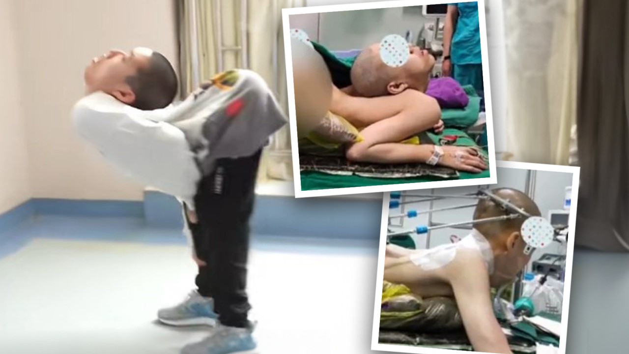 China’s ‘folded boy’, 19, takes first surgical step on the road to standing up straight for the first time in 10 years