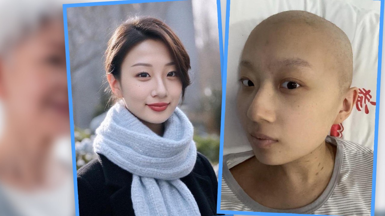 Hairless cancer-hit China woman uses AI to soften looks blow for grandmother