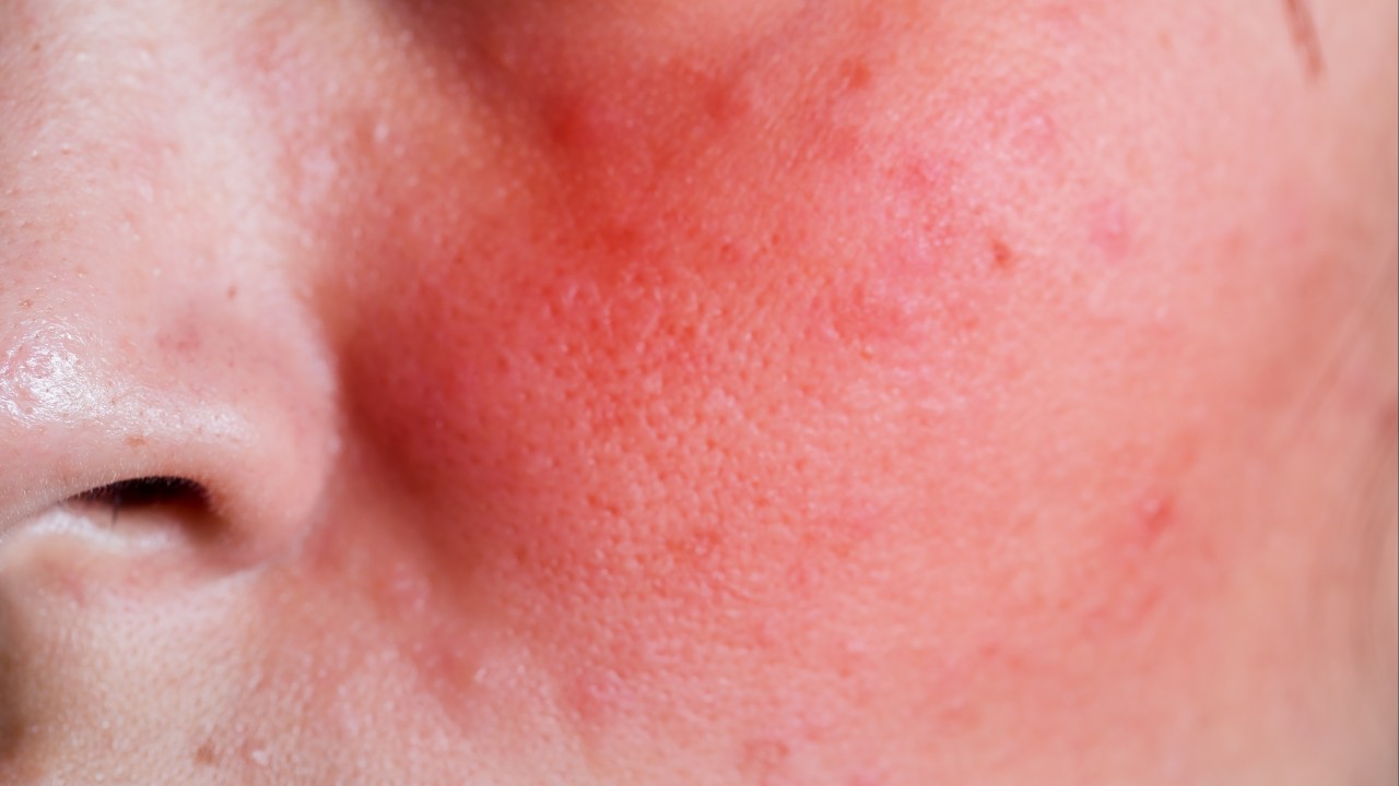 Japan faces worst ‘slapped-cheek syndrome’ outbreak in 25 years, pregnant women at high risk