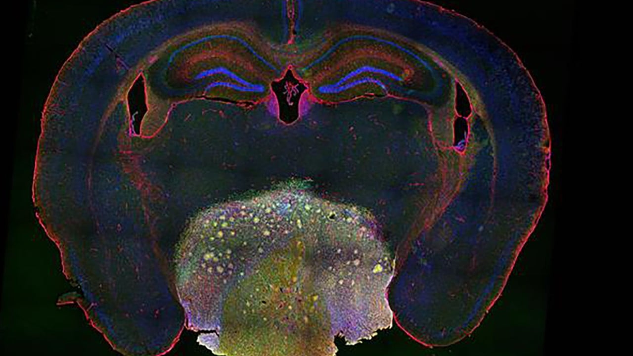 Chinese team finds blood pressure medication shows promise for treating rare brain tumour