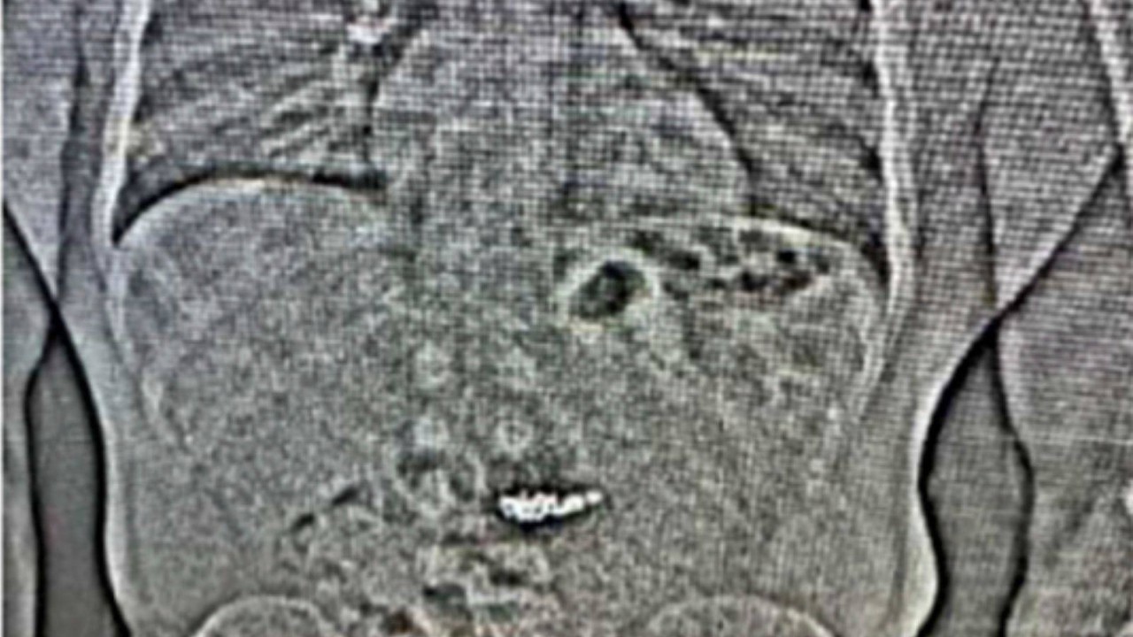 Suspected US robber swallows US$770,000 Tiffany diamond earrings during arrest