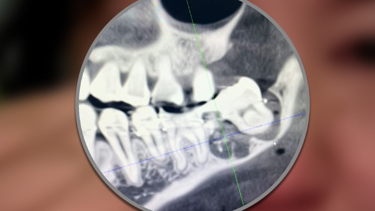 Chinese woman dies in hospital plunge after tooth extraction blunder causes ‘immense’ pain