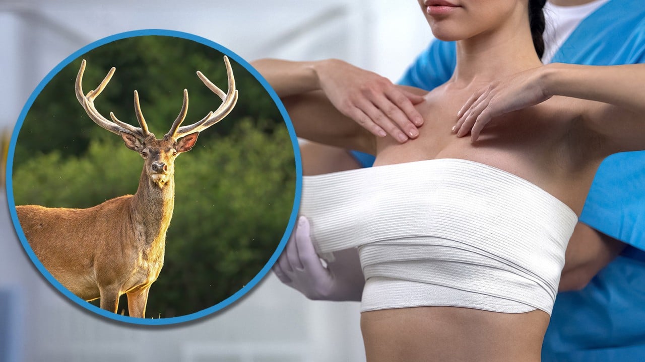 China US$332,000 breast implants with cattle DNA leave woman severly disabled