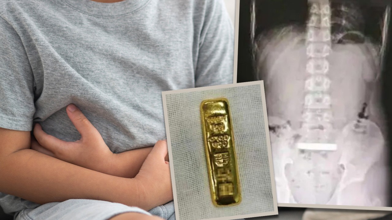 Chinese boy’s swollen abdomen leads to doctor, who discovers he has swallowed a gold bar