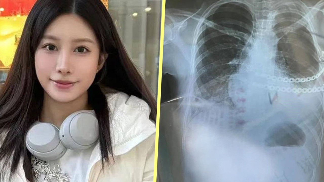 Chinese woman’s ‘jewellery breast’, snack shop’s ‘placenta processing’: 5 trending stories