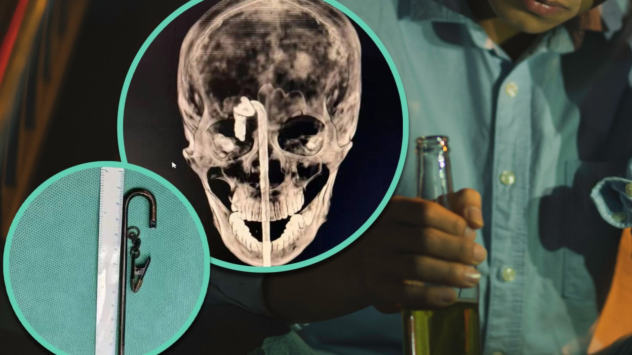 Drunk Chinese man impales himself on metal rod, needs 10-hour life-saving surgery