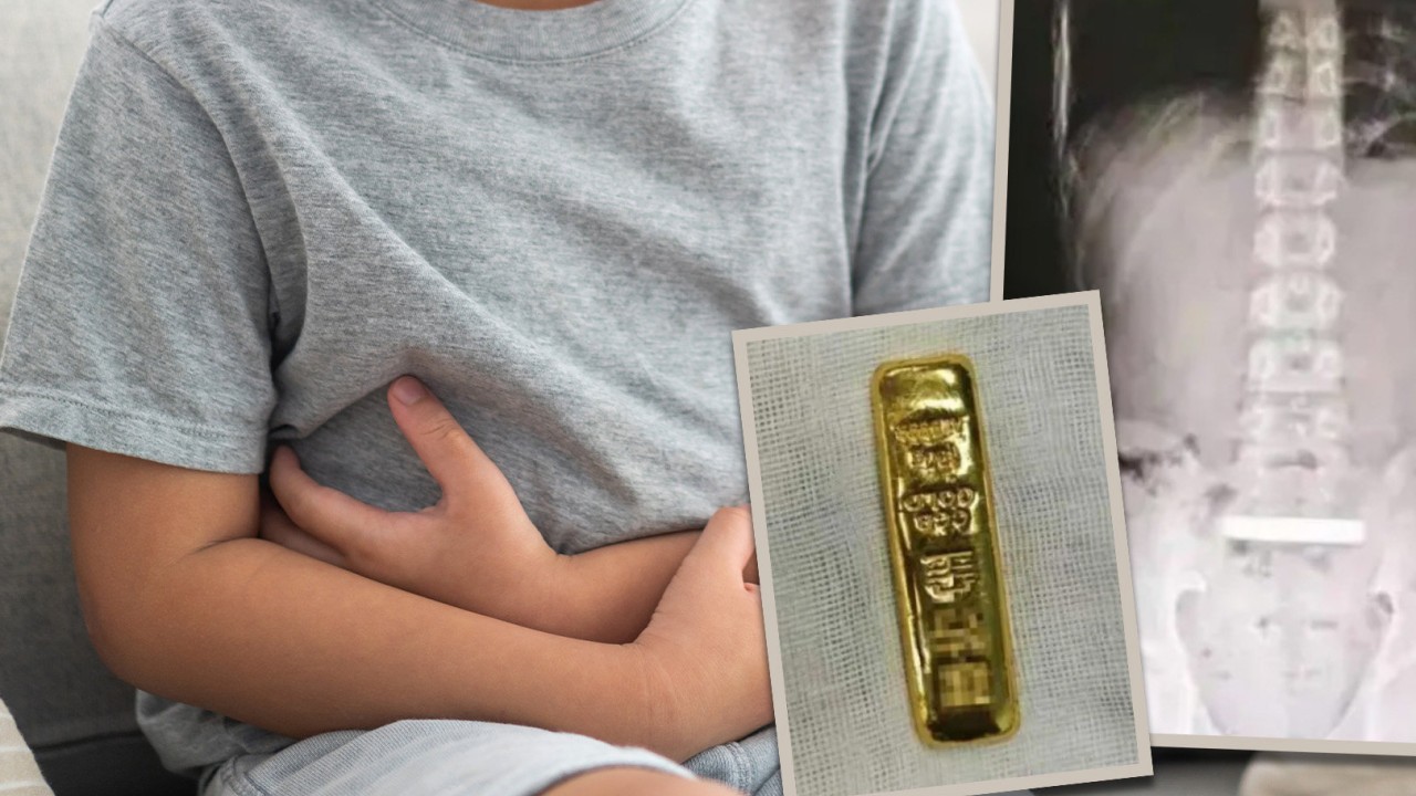 Boy swallows gold bar, China’s ‘miracle girl’, husband’s affair filmed: 5 trending stories