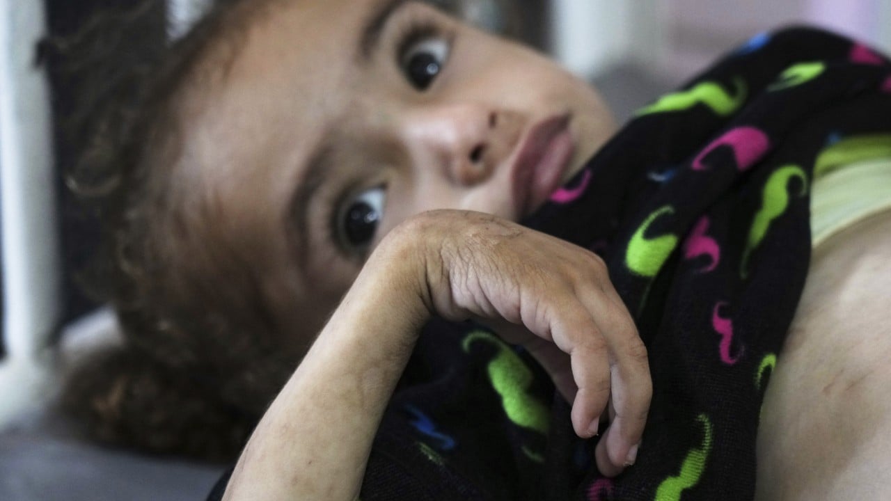 Gaza’s main hospital overwhelmed with children in pain from malnutrition
