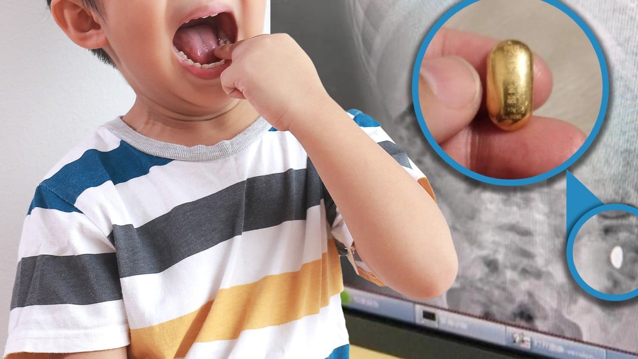 China boy swallows gold bean during ‘tongue exercise’, relieves himself in hospital