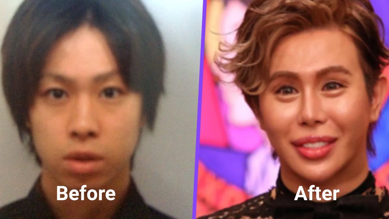 Japan bullying victim becomes ‘world’s most beautiful’ after US$650,000 plastic surgery