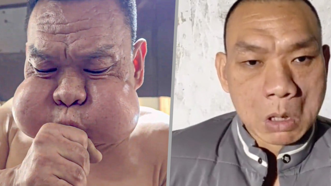 China ‘frog prince’ glassblower has unusually protruding cheeks after 30 years of work