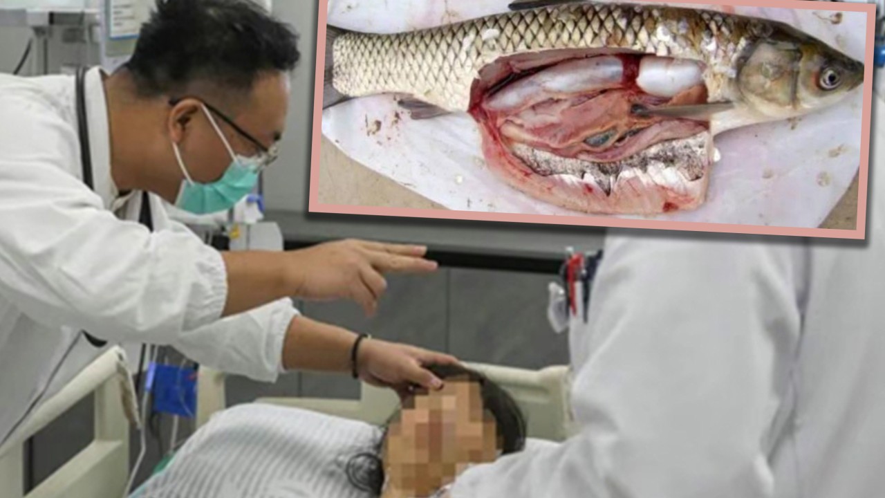 Chinese woman swallows raw fish gallbladder, hoping to relieve headache, ends up in ICU