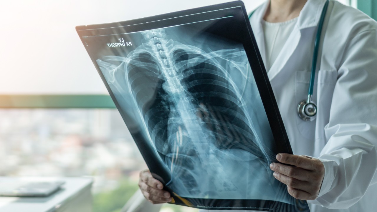 Malaysia risks under-reporting of TB cases as ‘slow-burn epidemic’ persists