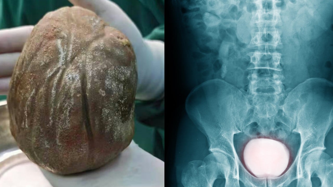 Chinese man who suffered painful urination for 3 years discovers 1.3kg stone in bladder