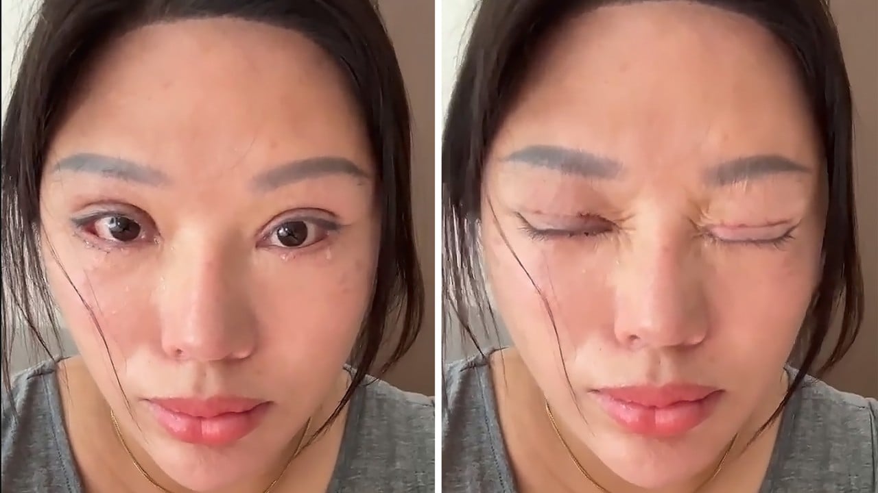 ‘Sleep with eyes open’: China woman’s bungled double eyelid surgery causes complications