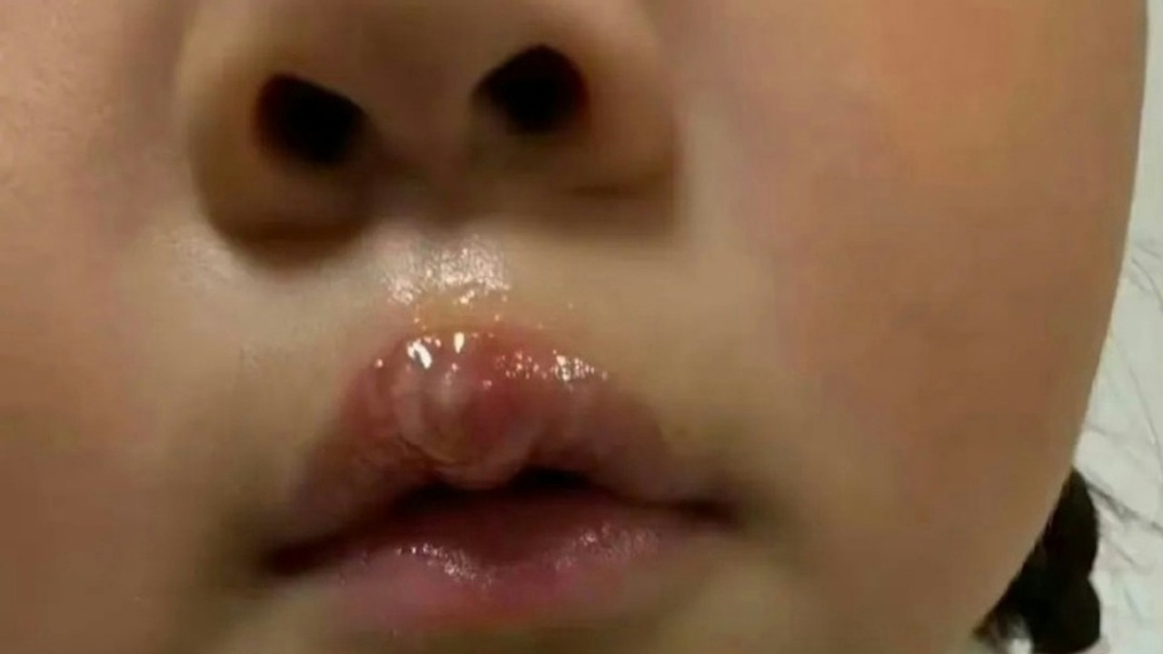 China teacher under probe after using glue gun to scald little girl, resulting in blisters