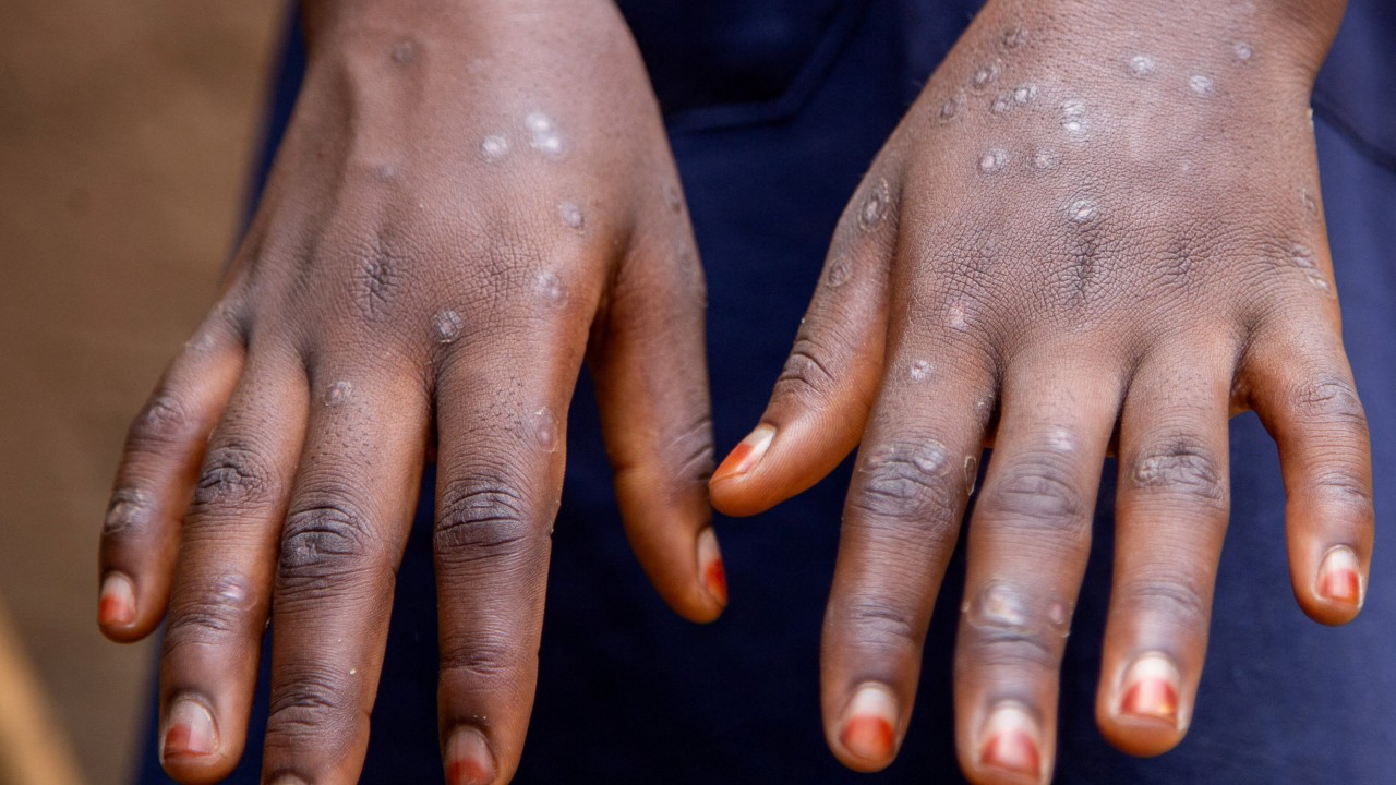 5 Mpox cases linked to Hong Kong ‘premier’ gay sau