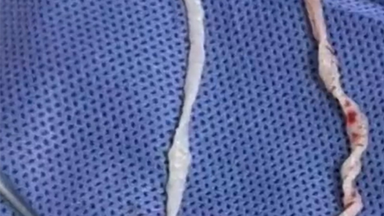 Chinese doctors remove pair of 10cm live worms from woman’s arm after year-long pain
