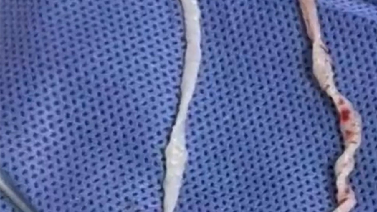 Chinese doctors remove pair of 10cm live worms from woman’s arm after year-long pain