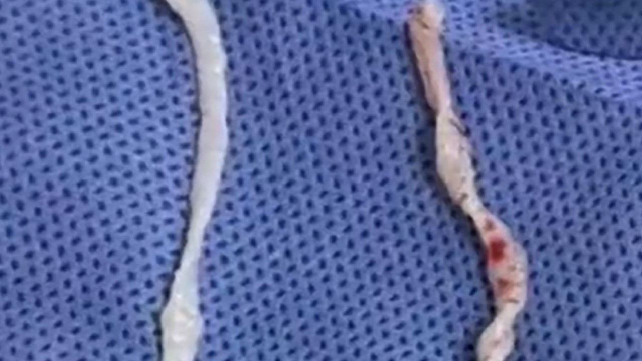 Chinese doctors remove 10cm live worms from woman's arm