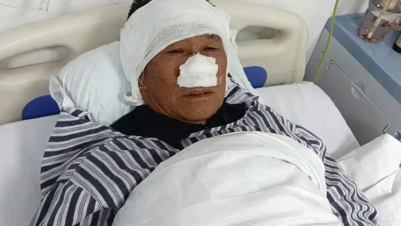 ‘True everyday hero’: Chinese man has nose bitten off saving woman from attacker