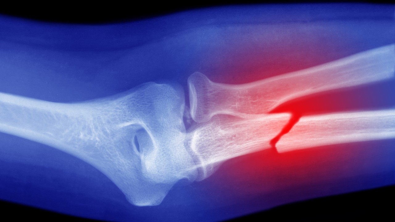 University to roll out screenings at pharmacies to uncover osteoporosis cases
