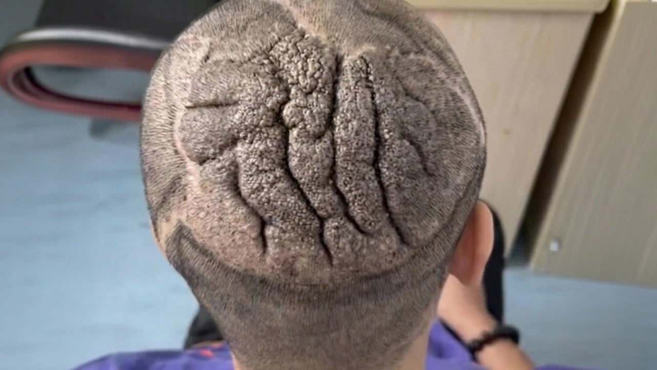 Rare medical condition causes Chinese man’s scalp to thicken and fold, resembling human brain
