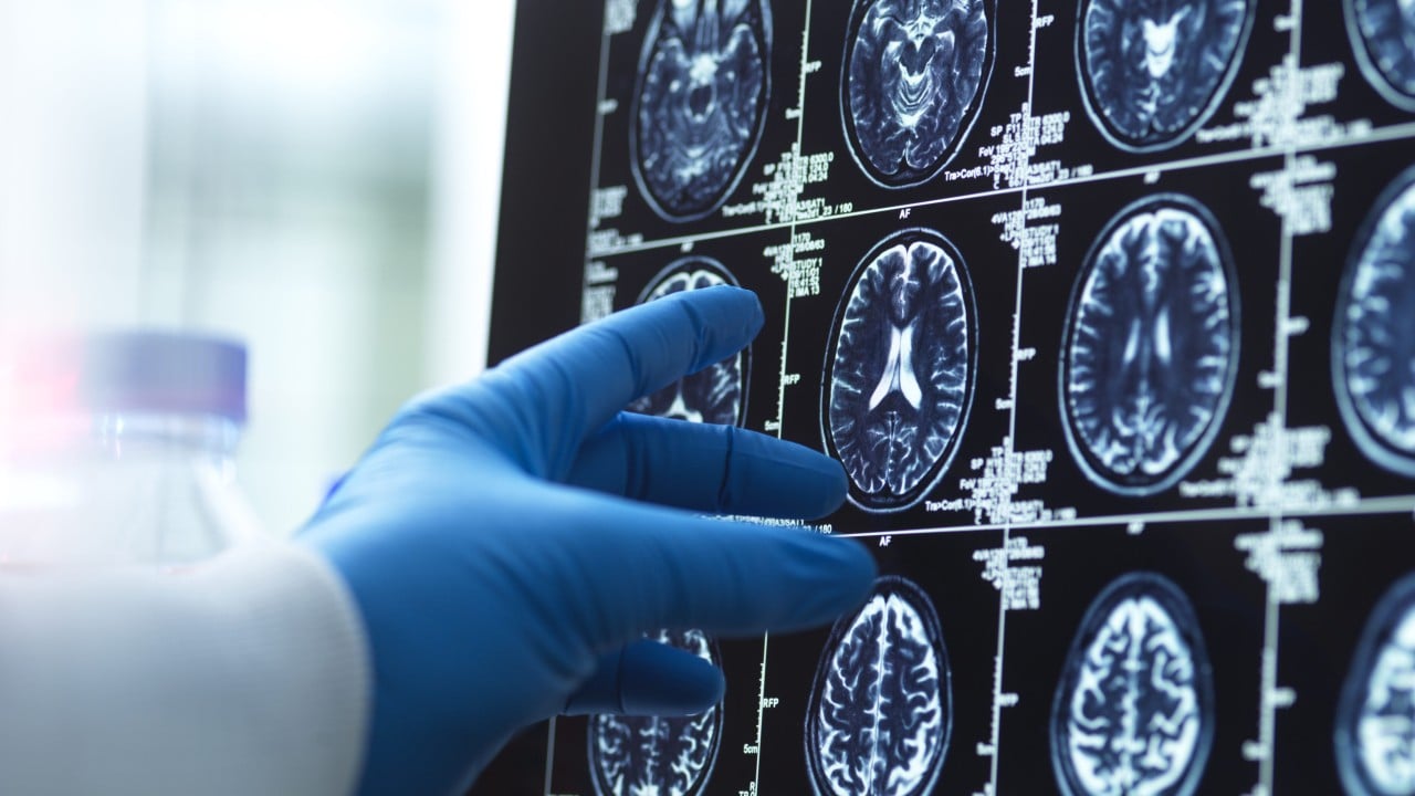 Japanese surgeon removes healthy brain tissue, leaving woman on ventilator