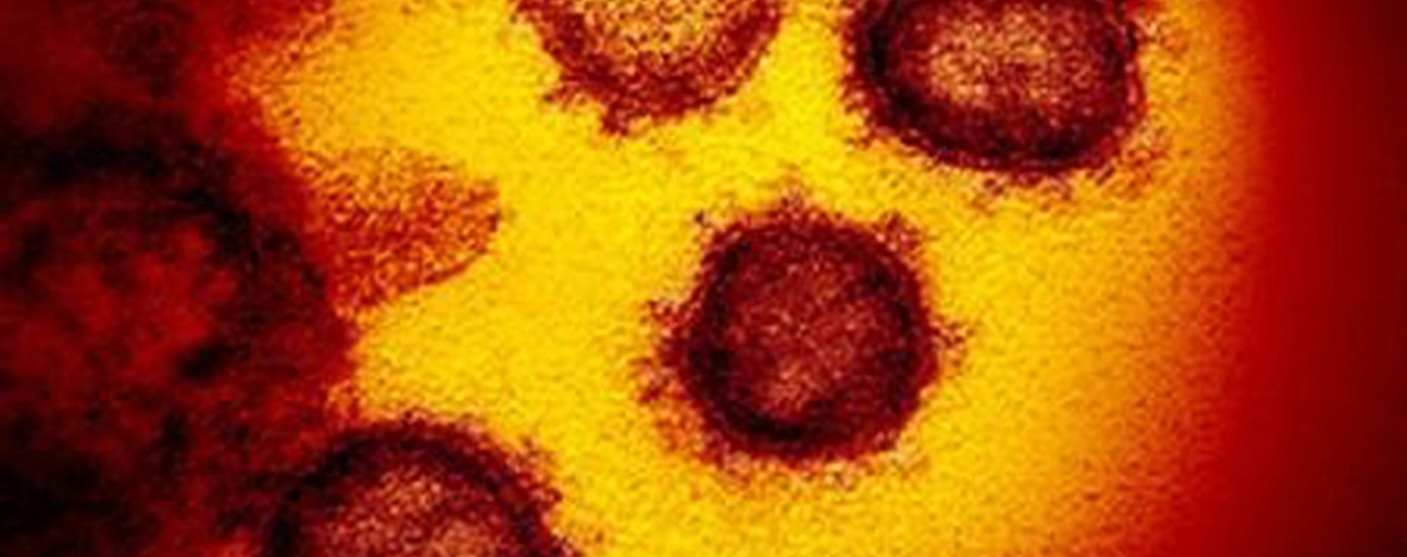 This transmission electron microscope image shows SARS-CoV-2, the virus that causes COVID-19, isolated from a patient in the U.S., emerging from the surface of cells cultured in the lab. Photo: NIAID