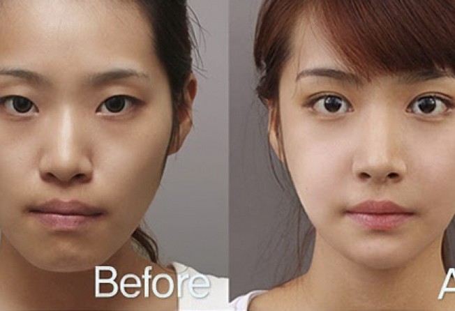 Before and after double eyelid surgery.