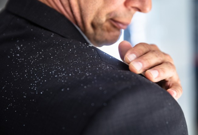 There are a number of ways to treat dandruff. Photo: Getty Images