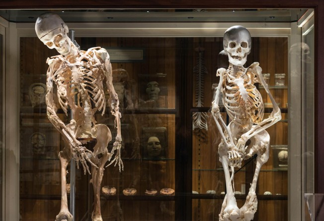 The skeletons of Harry Eastlack (left) and Carol Orzel (right). They lived with FOP, an ultra-rare disease that caused their bodies to grow bone where it does not usually grow. Photo: Constance Mensh for the Mütter Museum of The College of Physicians of Philadelphia