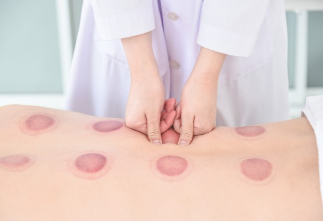 A TCM therapist doing a massage on a patient after cupping therapy. Photo: Shutterstock Images
