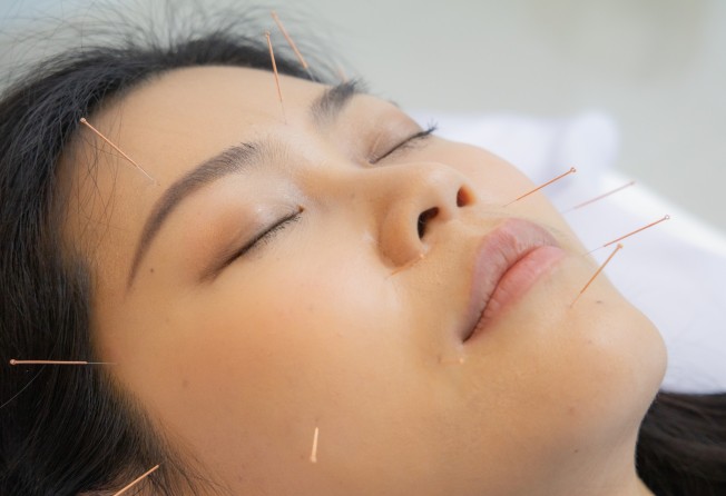 Studies have found acupuncture to be effective in patients with sexual disorders. Photo: Shutterstock
