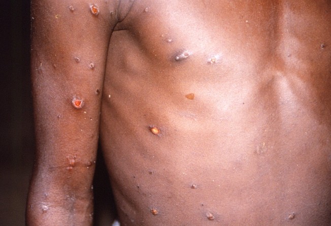 The arms and torso of a patient with skin lesions due to monkeypox. Photo: CDC/handout via Reuters
